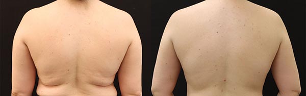 Evolve body contouring- Back before and after photo