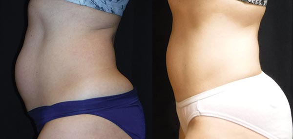 Evolve body contouring- Stomach before and after photo