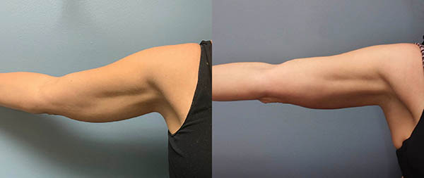 Evolve body contouring- Arm before and after photo